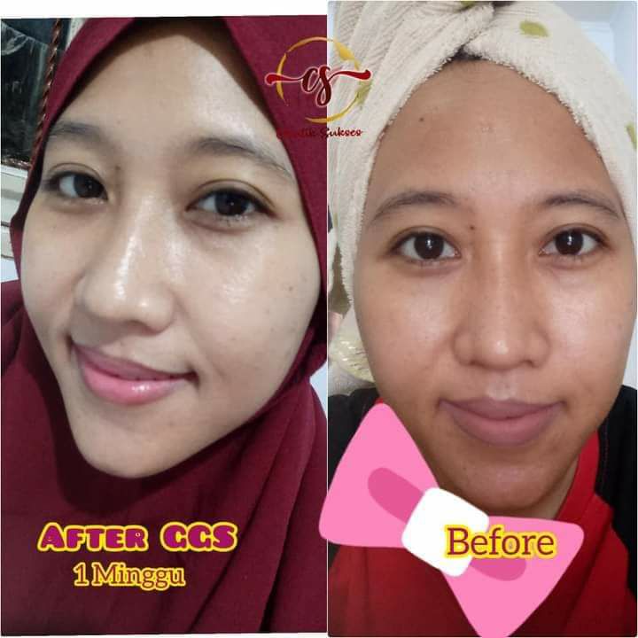 👆Ini bukan habis 7 paket ya...Tapi hasil 7 kali oles ya, 7 malam berturut2, jadi blum habis 1 paket ya...Tidak terjadi pengelupasan berat lo...tetiba aja wajahmu glowing maksimal cerah alami gitu...ikutin saja prosesnya dan petunjuk pemakaiannya okkeeey...🤗🤩🥰Wajah makin mulus, halus, glowing maksimal, pori2 tampak mengecil , wajah makin cerah alami tampak muda kembali. MAU  ??? japri kuys...👆Ini bukan habis 7 paket ya...Tapi hasil 7 kali oles ya, 7 malam berturut2, jadi blum habis 1 paket ya...Tidak terjadi pengelupasan berat lo...tetiba aja wajahmu glowing maksimal cerah alami gitu...ikutin saja prosesnya dan petunjuk pemakaiannya okkeeey...🤗🤩🥰Wajah makin mulus, halus, glowing maksimal, pori2 tampak mengecil , wajah makin cerah alami tampak muda kembali. MAU  ??? japri kuys...