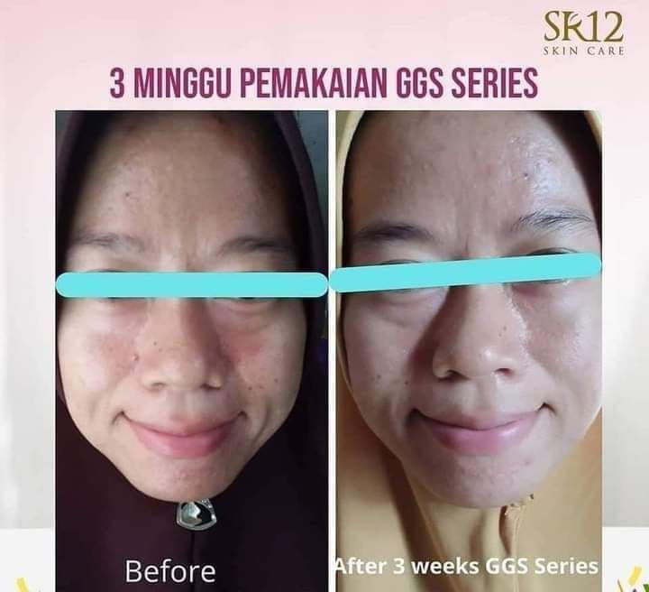 🌸 Ada yg 3 hari dan ada yg 7 hari udah tampak cerah, ada yg 2 mingguan baru terlihat hasilnya, karna kulit kita jenisnya berbeda, berbeda pula tingkat kecepatan responnya. Namun yg jelas GGS series ini emang Mantul👍🌸 Kalau ada yg SEHAT AMAN dan bisa BEREAKSI dengan CEPAT, kenapa harus pilih yang lain? PILIH aja Glow Glass SkinGel nya SR12 dong🌸Tetiba aja wajahmu glowing maksimal cerah alami gitu, ikutin saja prosesnya & petunjuk pemakaiannya okkey🤩🌸 Kenapa GGS(glow glass skin Gel) bisa bikin kulit cerah dengan cepat? Itu karena GGS mengandung 5 bahan  aktif pencerah Wajah5 bahan aktif bekerja sekaligus, hayo gimana nggak cerah maksimalWajah makin mulus, halus, glowing maksimal, pori2 tampak mengecil, wajah makin cerah alami tampak muda kembaliMau ?japri kuys..WA/telegram👉0821-5799-8873AGEN RESMI SR12 HERBAL SKINCARE BALIKPAPAN KAL-TIMMampir yuks 👇shopee.co.id/agenresmisr12Atautokopedia.com/sr12balikpapanBisa pakai voucher free ongkir dan bisa COD  & promo menarik lainnya GERCEEP 🥳