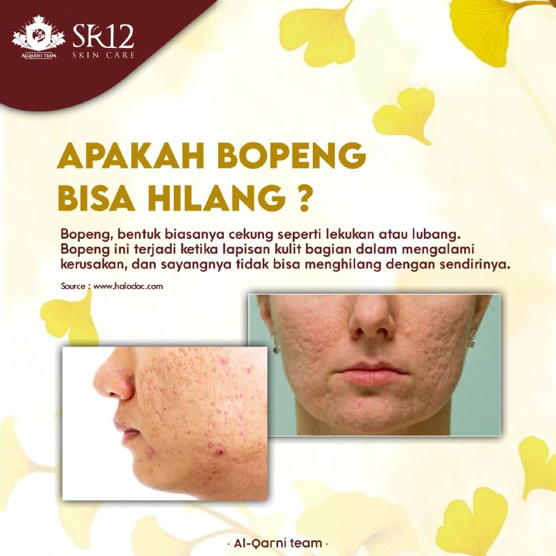 Apakah Bopeng bisa hilang dengan sendirinya ? No no no, karena bopeng  adalah bagian dalam kulit yg sudah mengalami kerusakan,.maka bopeng tidak bisa menghilang sendiri tanpa perawatan ya...dalam hal ini SR12 HERBAL SKINCARE Memberikan solusi untuk masalah bopeng yg mengganggu penampilan mu...dengan produk paket perawatan penghilang bopeng SR12 yg efektif and berkhasiat...mantuuul👍👍👍 CHECK 👉👉👉